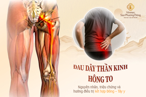 Đau dây thần kinh hông to: Nguyên nhân, triệu chứng và hướng điều trị kết hợp Đông – Tây y