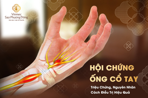 Hội Chứng Ống Cổ Tay – Triệu Chứng, Nguyên Nhân và Cách Điều Trị Hiệu Quả